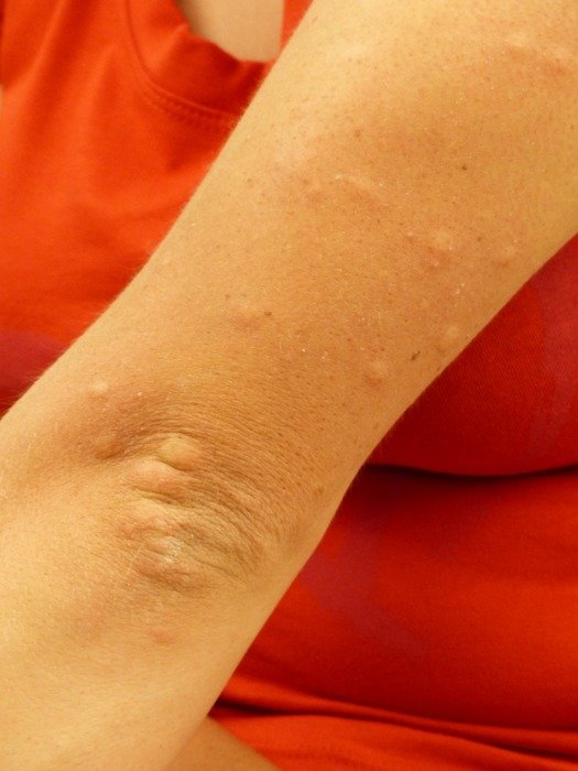 Mosquito bites on a human hand at red background