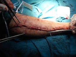 suturing the wound on the arm in surgery