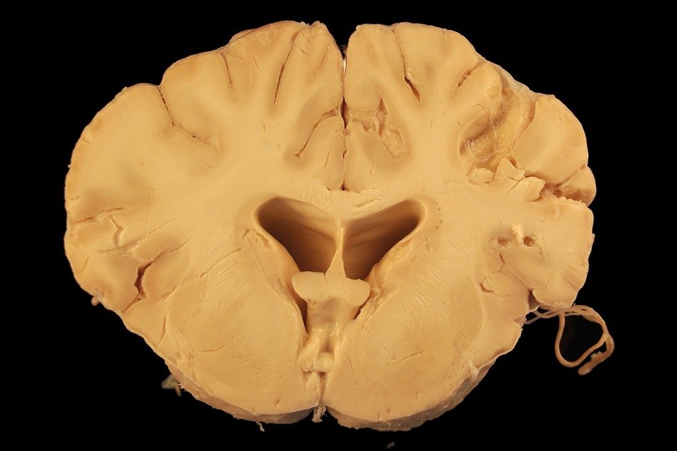 ventricle of the human brain