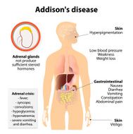 Addison&#039;s disease