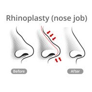 Human Nose Job Before &amp; After N2