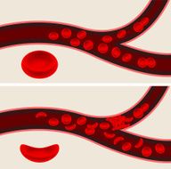 human blood cells and sickle cell anemia flow veins