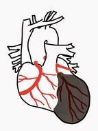 Enlarged Heart drawing