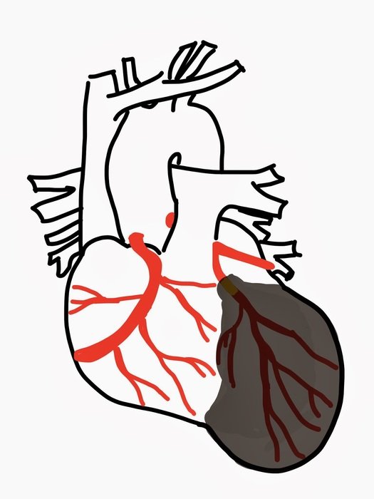 Enlarged Heart drawing