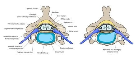 posterior central disc protrusion