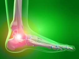 drawing of Pain in Foot Ankle