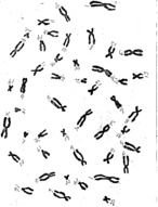 Klinefelters Syndrome Karyotype Http biologyjunctioncom karyotype