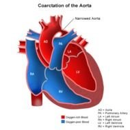 Anatomy Of A Heart With Coarctation The Aorta