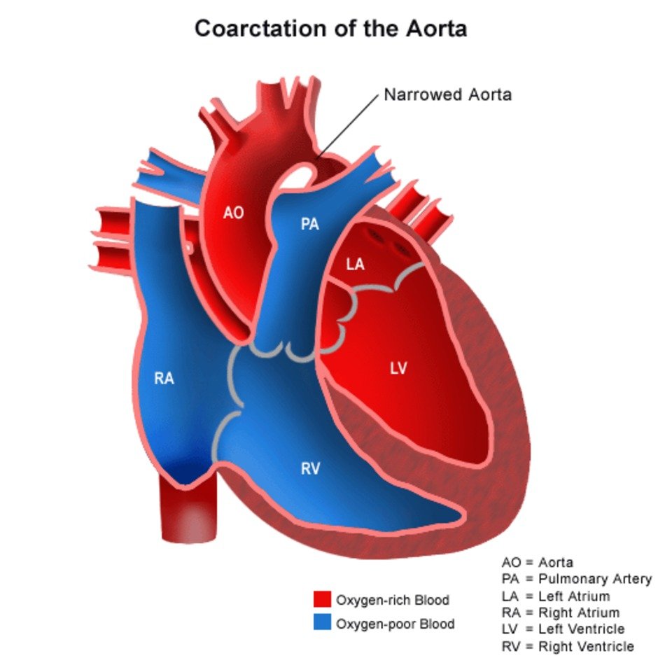 Anatomy Of A Heart With Coarctation The Aorta