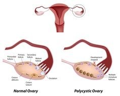 Polycystic Ovarian Syndrome, drawing