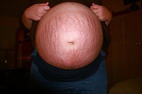 pregnant woman's belly with stretch marks