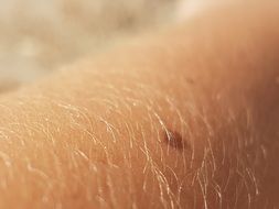 Skin Hair