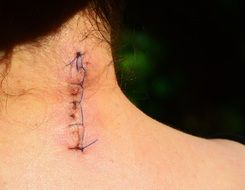seamed wound