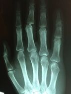 Hand Fracture Broken