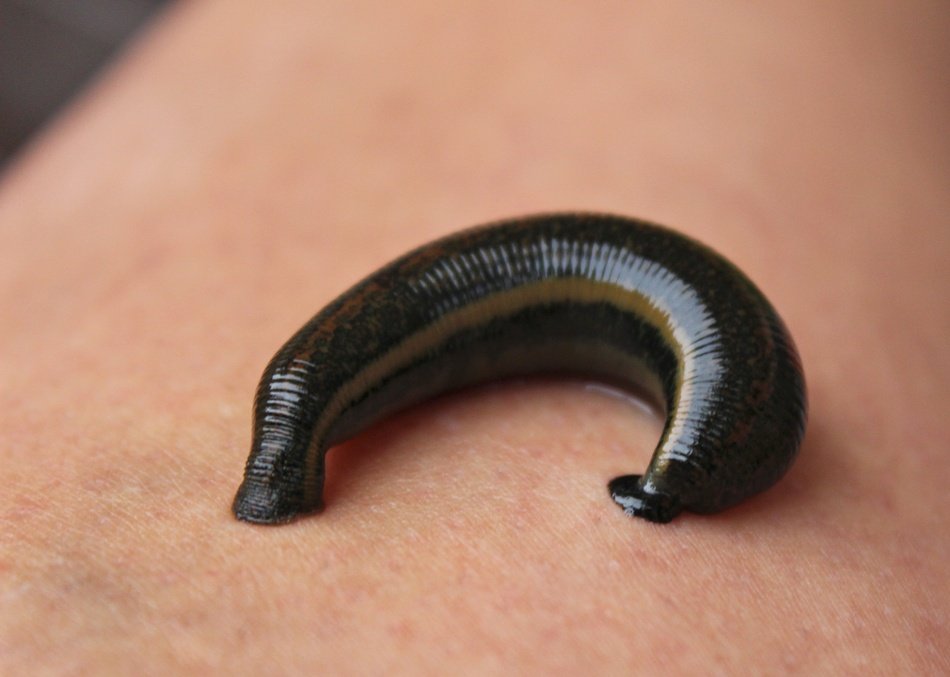 Picture of Leech Therapy