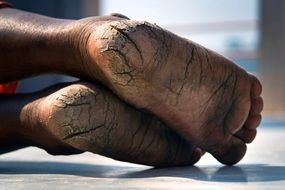 feet in deep cracks close up