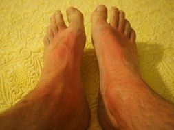 legs in sunburn close-up