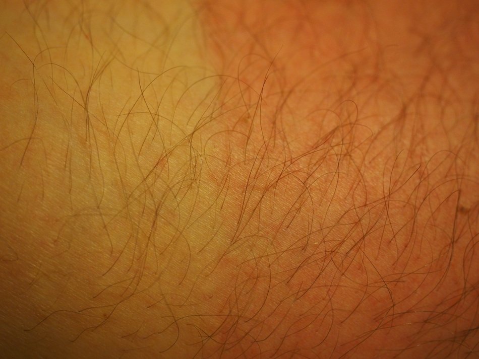 Suburn on the skin