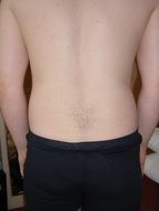 Back Pain
