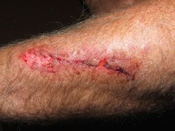 close-up picture of wound on the arm