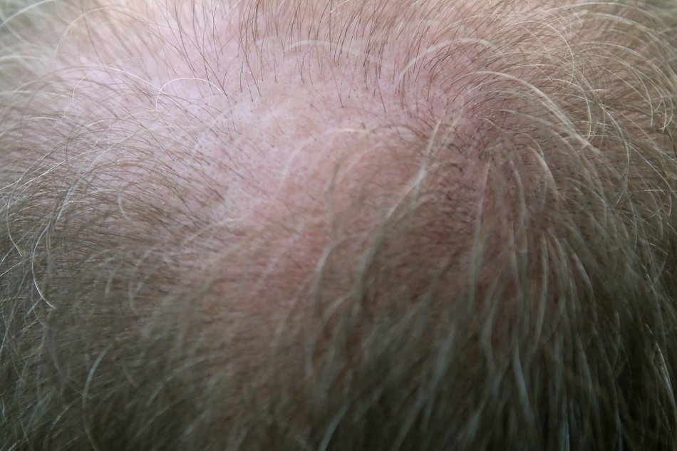 Balding, old manâs hairs close up