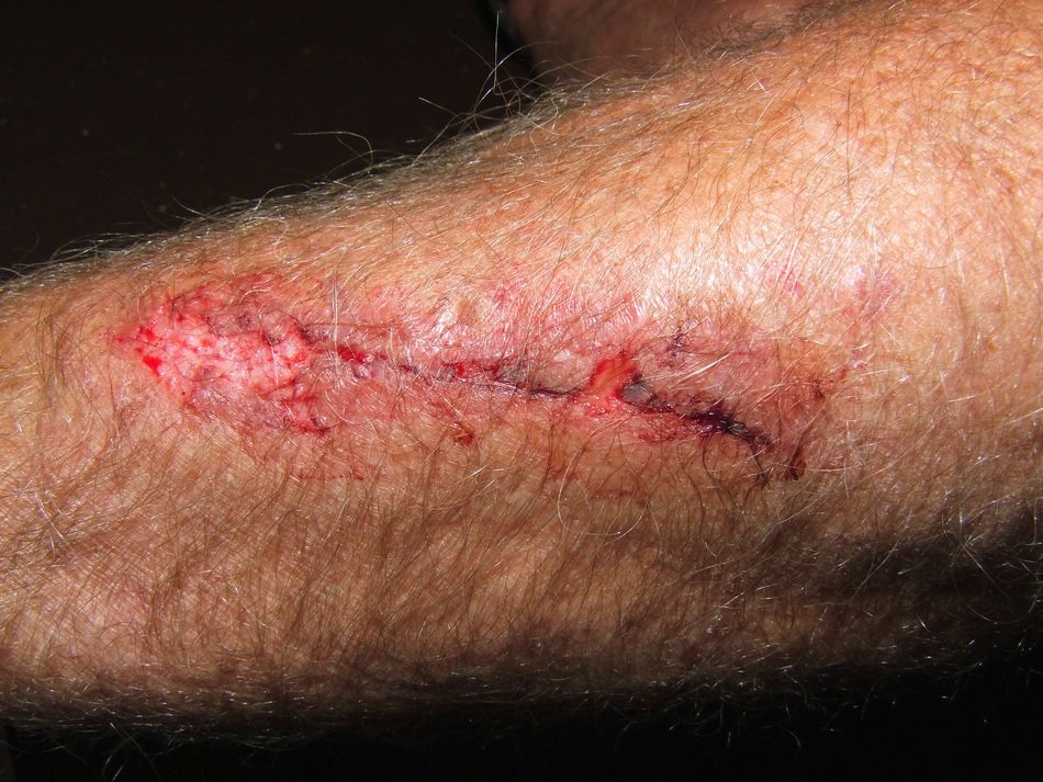close-up picture of wound on the arm
