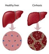 Healthy liver and Cirrhosis as picture for clipart