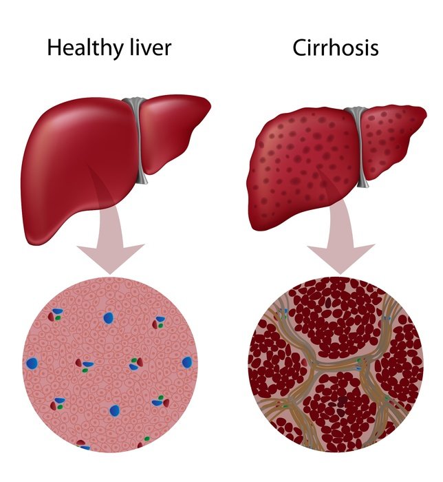 Healthy liver and Cirrhosis as picture for clipart