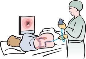 Colonoscopy as a graphic illustration