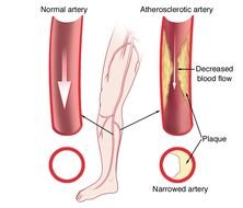 Peripheral Artery Disease