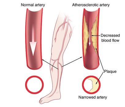 Peripheral Artery Disease