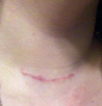 Thyroid Surgery Scar free image download