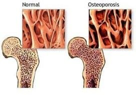 Tulang Normal Dan Osteoporosis drawing