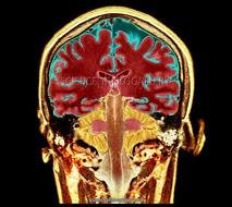 Healthy Brain MRI
