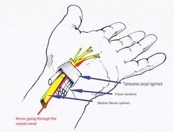 Carpal Tunnel Syndrome