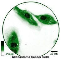 Brain Cancer Cells