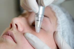 procedure of microdermabrasion