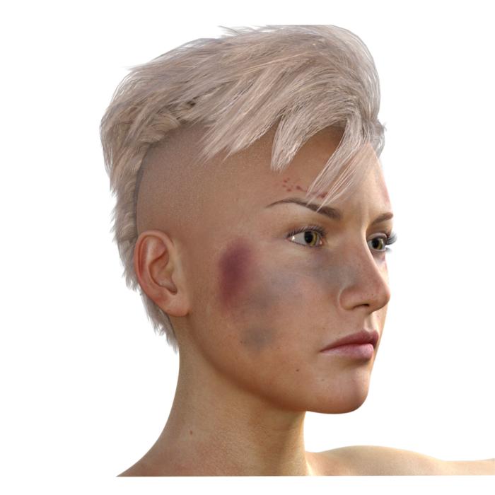 woman haematoma fight black eye