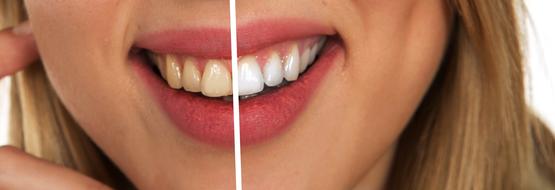 tooth before and after care
