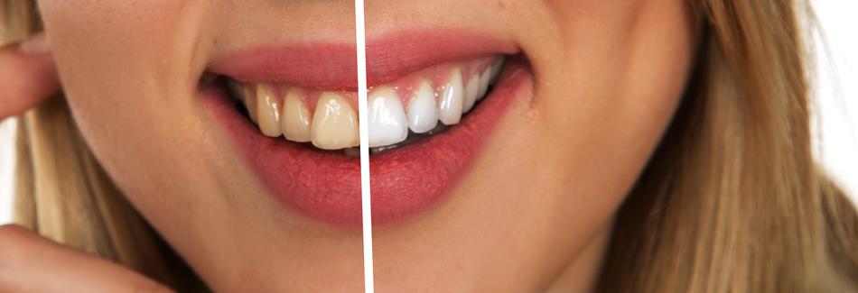 tooth before and after care