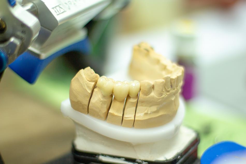 Tooth Replacement Dentist model