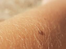 Skin Hair
