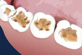 dental tooth enamel erosion