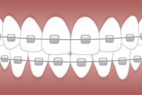 braces teeth dentist drawing