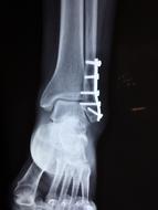 x-ray of human foot