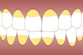 dental calculus teeth drawing