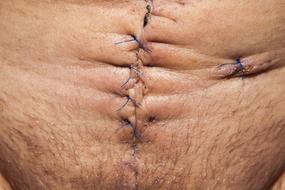 stitched stomach after surgery