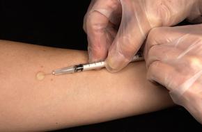 Tuberculin Test hand