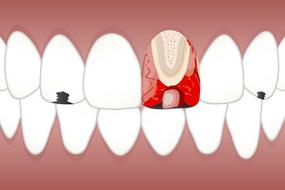 dental pulpitis white drawing