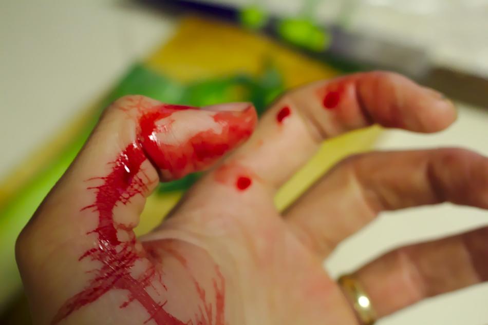Accident Bleed hand